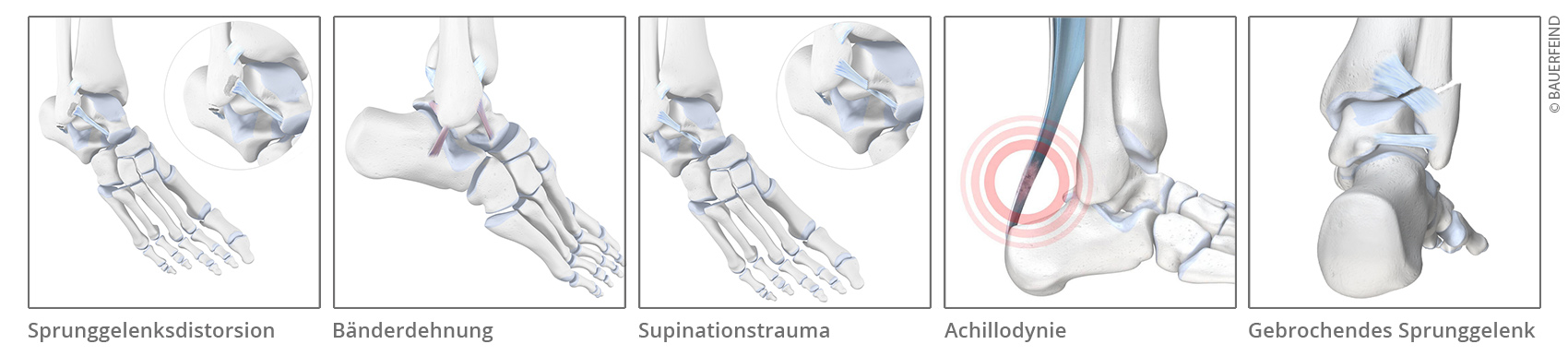 Verletzungen im Sprunggelenk